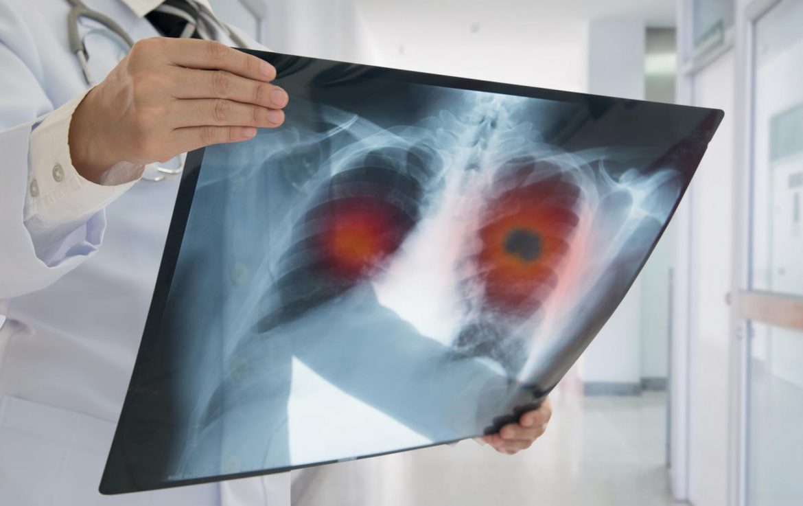U Vojvodini se nastavlja projekat ranog otkrivanja raka pluća