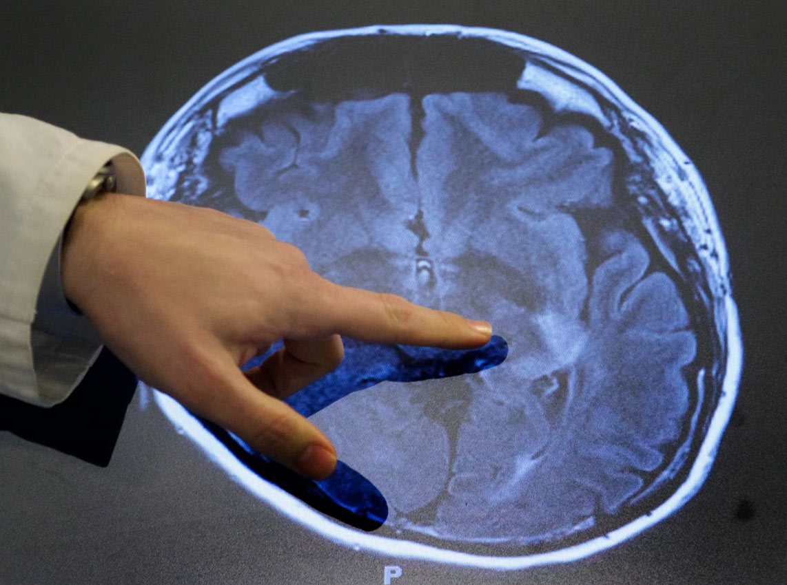 Lek za moždani udar nudi neuroprotekciju bez dugotrajnog uticaja na pamćenje i učenje