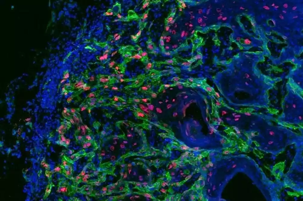 Identifikovana hranljiva materija za kojom „žude“ ćelije raka