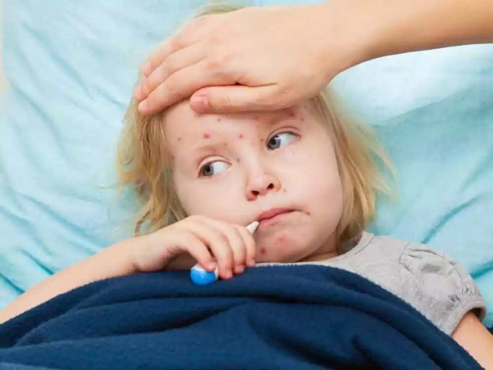 Epidemija morbila u Ohaju zarazila je 82 dece, od kojih većina nije vakcinisana