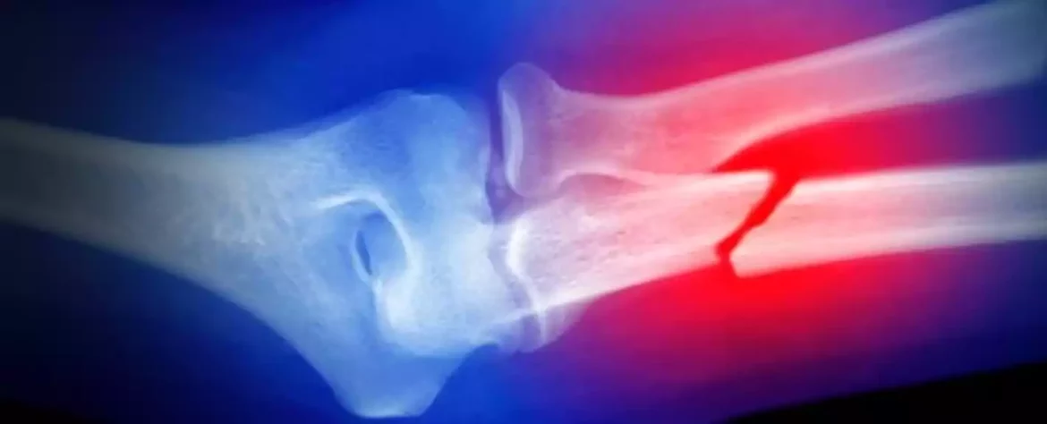Korišćenje prekursora ćelija koštane srži umesto transplantacije za regeneraciju kosti