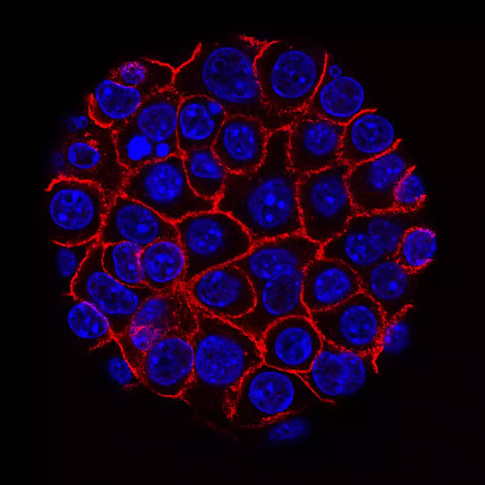 Kako rak pankreasa prkosi lečenju korišćenjem proteina