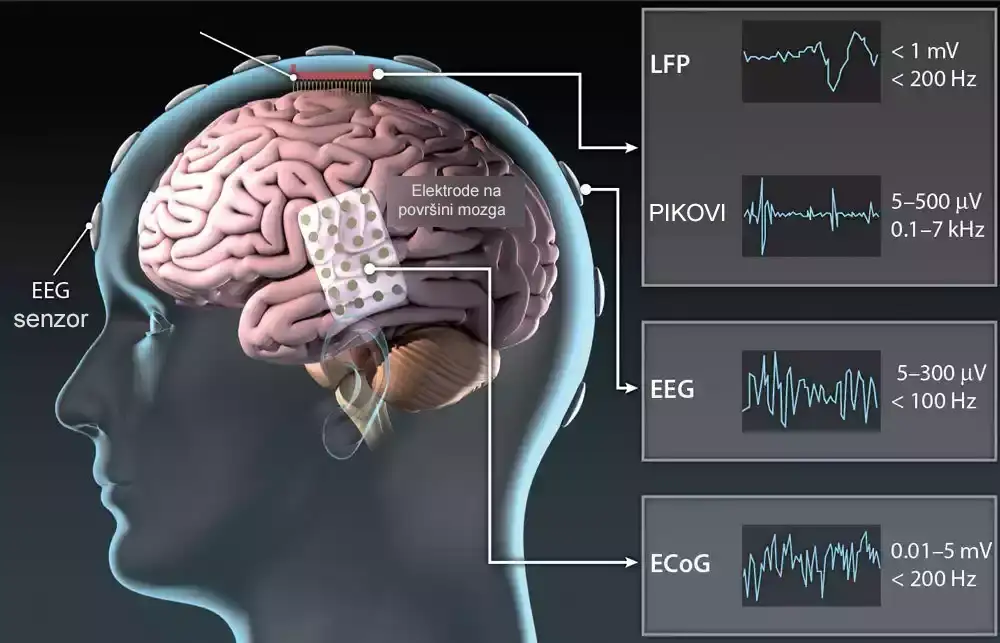 Neuralna proteza koristi aktivnost mozga za dekodiranje govora