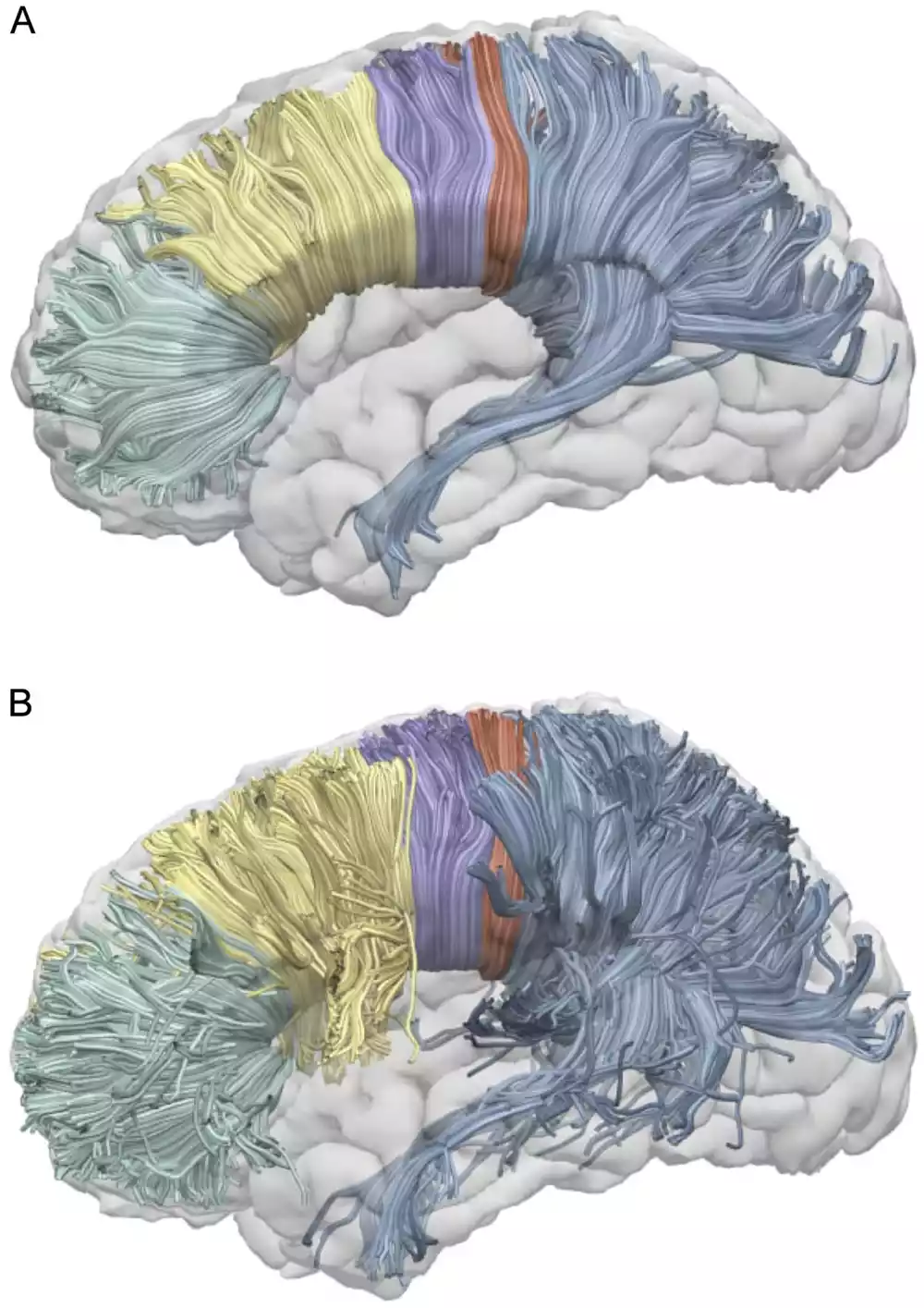 Utvrđeno je da corpus callosum isključuje desnu hemisferu tokom govora