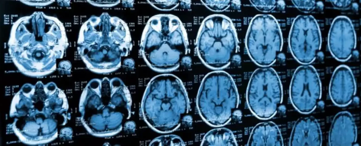 Normalizacija krvnih sudova tumora može poboljšati imunoterapiju protiv raka mozga