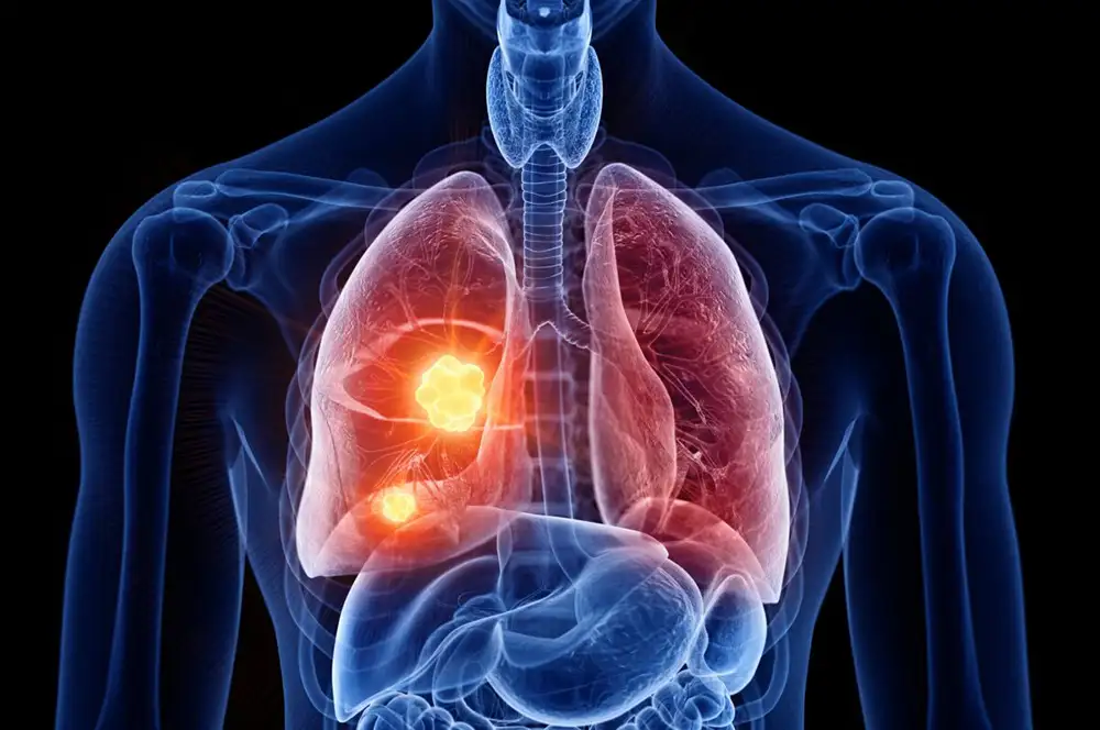 Nivolumab pokazuje dugoročnu korist kod karcinomoma pluća ne-malih ćelija