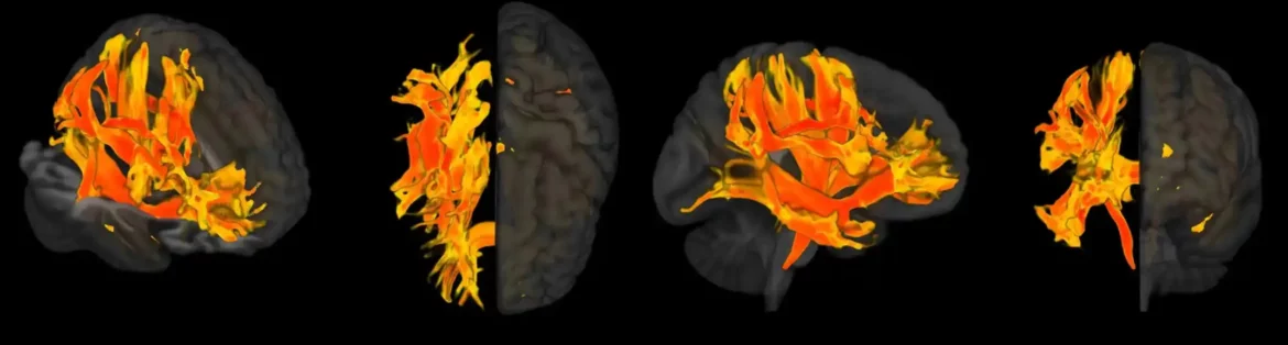 Specifične regione mozga oštećene visokim krvnim pritiskom doprinose mentalnom padu, demenciji