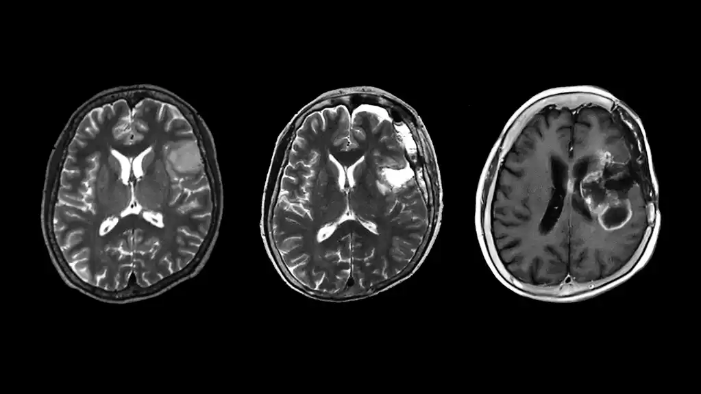 Pacijenti sa retkim tipom tumora neurona imaju lošiju prognozu od očekivane