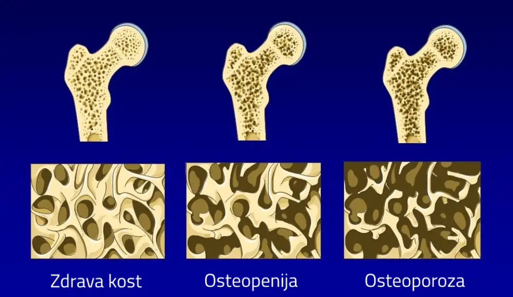 Nedostatak proteina HERC1 uzrokuje osteopeniju
