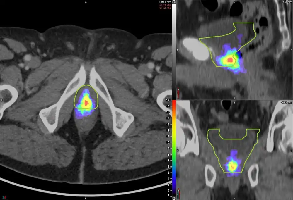 PSMA PET skeniranje može poboljšati donošenje odluka za lečenje raka prostate