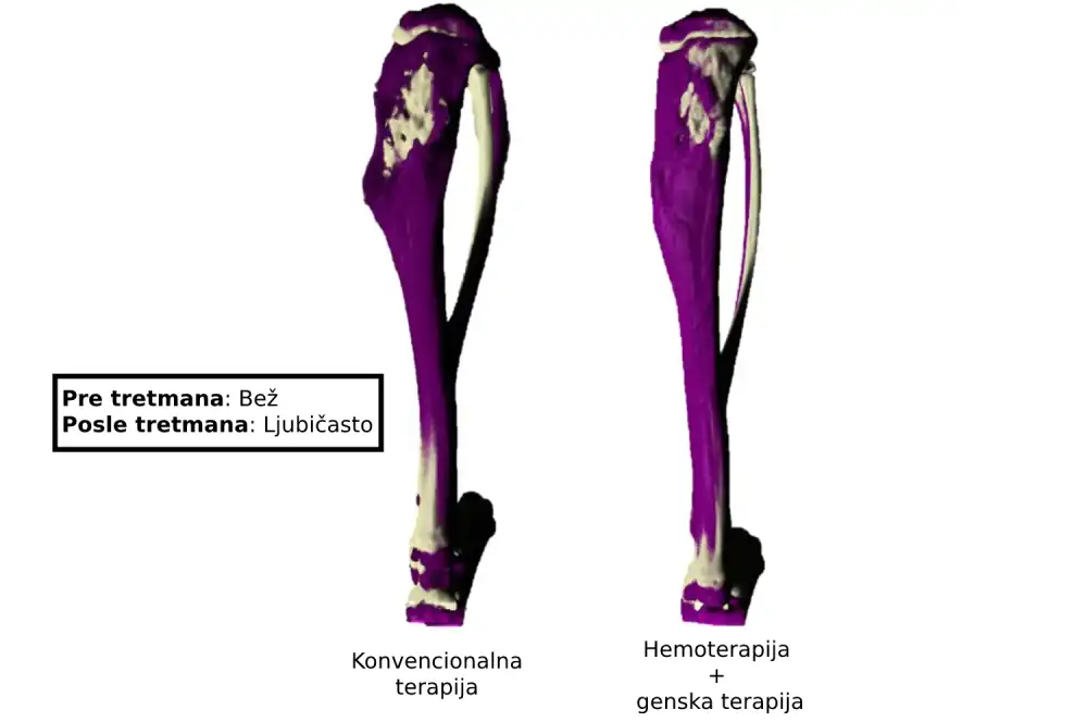 Kombinacija genske terapije i hemoterapije može pružiti novu opciju lečenja raka kostiju