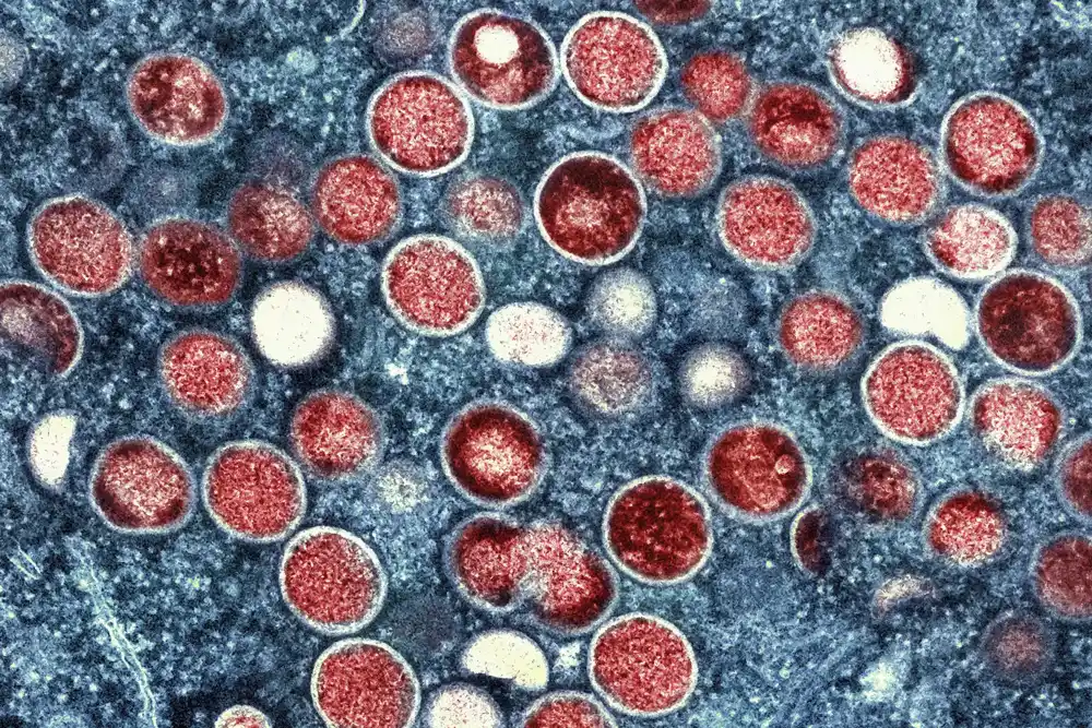 Mpox je u padu, ali američki gradovi bi mogli biti u opasnosti