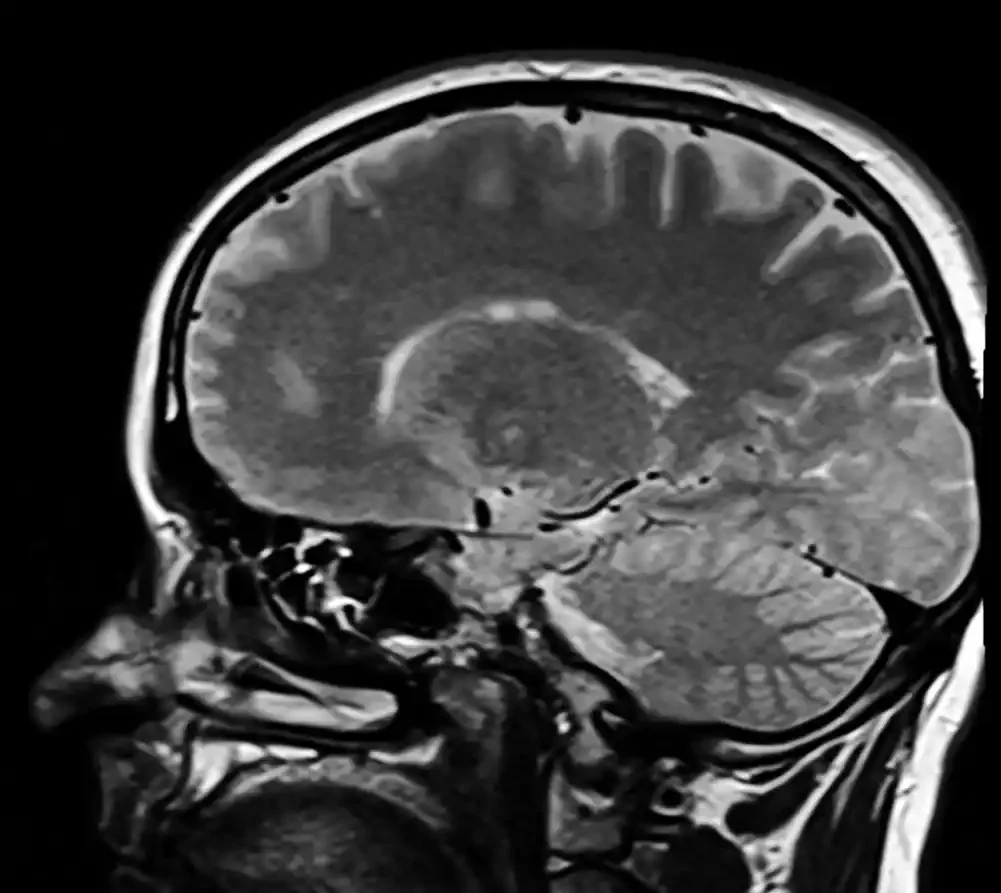 Veštačka inteligencija efikasna u dijagnostici raka glave i vrata