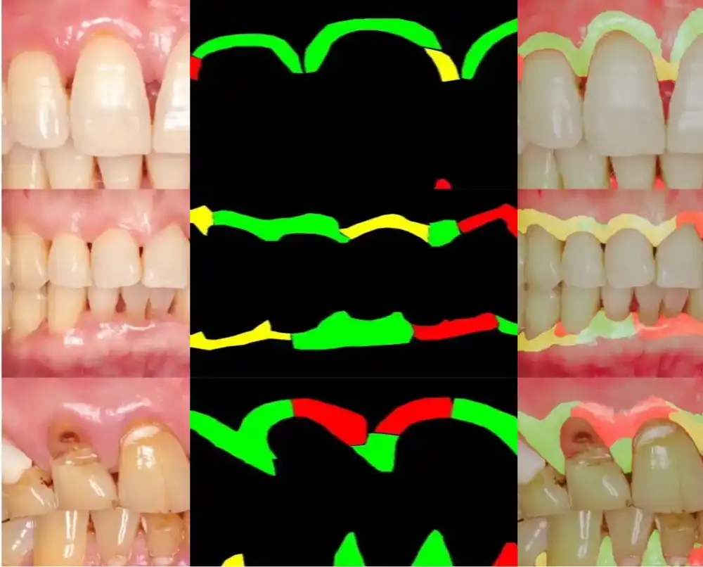 Stomatološki tim koristi veštačku inteligenciju za rano otkrivanje upale desni