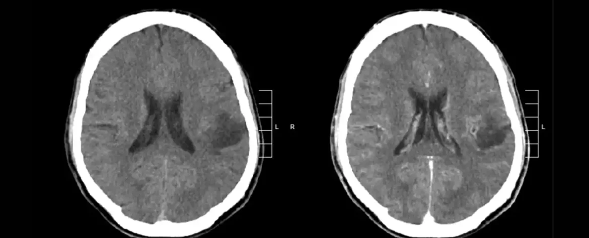 Sigurniji, brži, manji ožiljak: Novi pristup hirurgiji mozga cilja na teške tumore na bazi lobanje