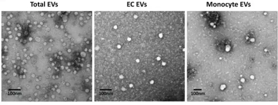 Istraživači otkrivaju novi biomarker za ozbiljnost sepse