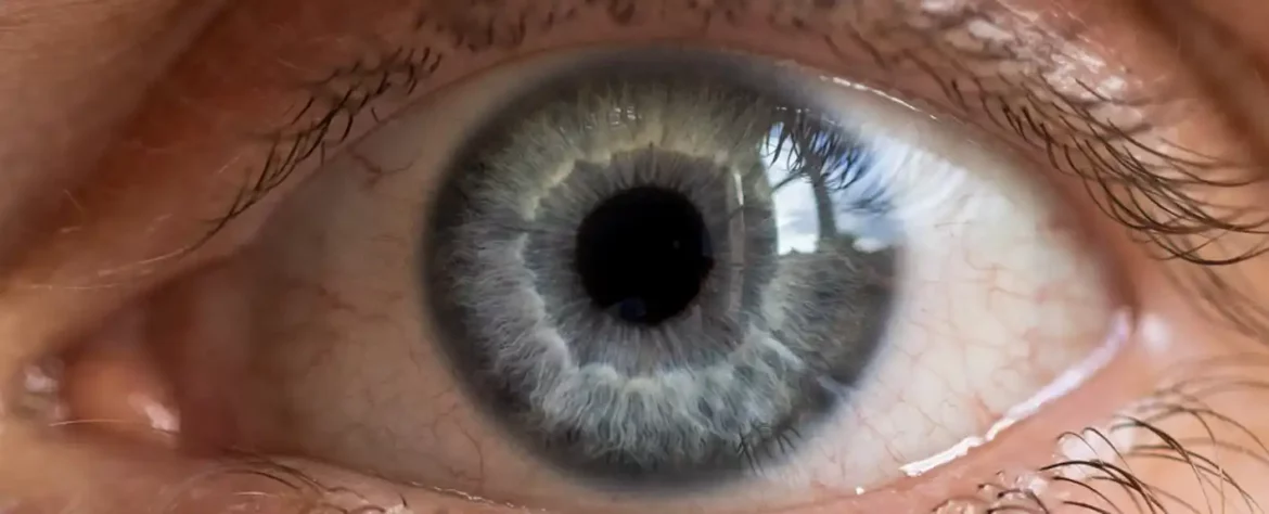 Korišćenje veštačke inteligencije za otkrivanje bolesti suvog oka