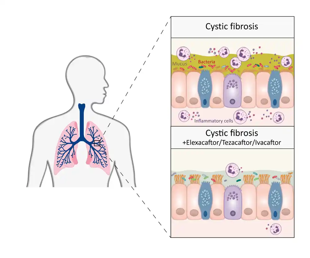 Trostruka kombinovana terapija donosi trajno poboljšanje cistične fibroze, pokazuje studija