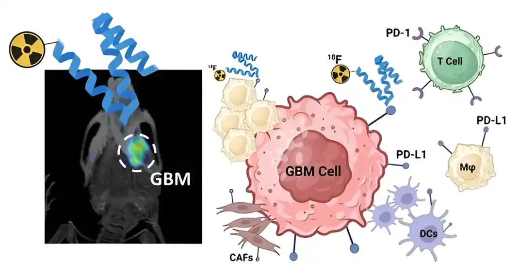 Novi pristup skriningu ima potencijal da produži preživljavanje kod glioblastoma