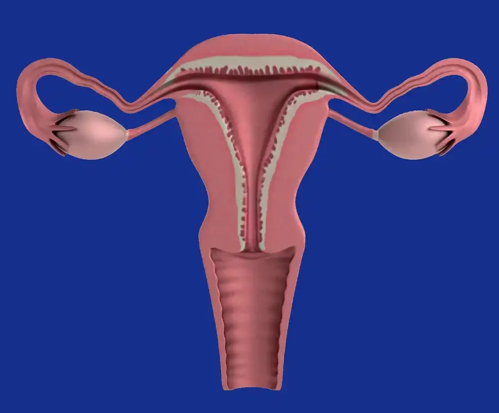 Istraživači razvijaju hidrogel implantat za lečenje endometrioze