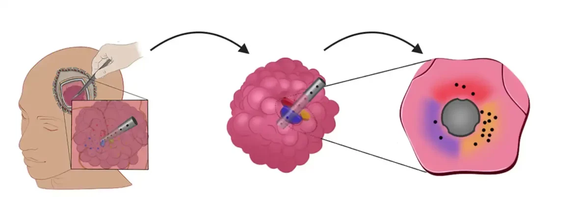 Mikrouređaji implantirani u tumore nude novi način lečenja raka mozga