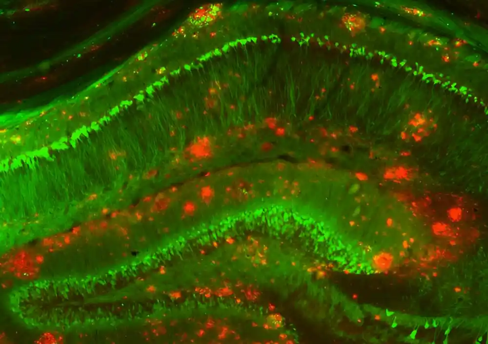 Naučnici otkrivaju ćelijske promene jedinstvene za ranu Alchajmerovu bolest