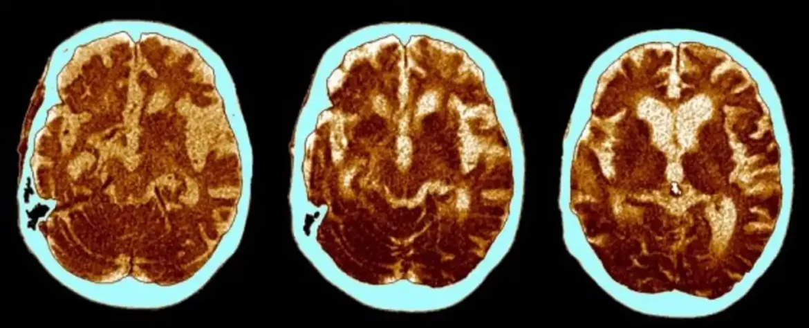 Polomljene moždane veze, a ne nakupine proteina, mogu biti iza Alchajmerove bolesti