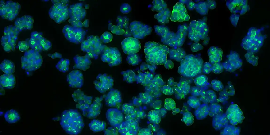 Istraživanja otkrivaju kako rak otima imune ćelije da bi podstakao rast tumora