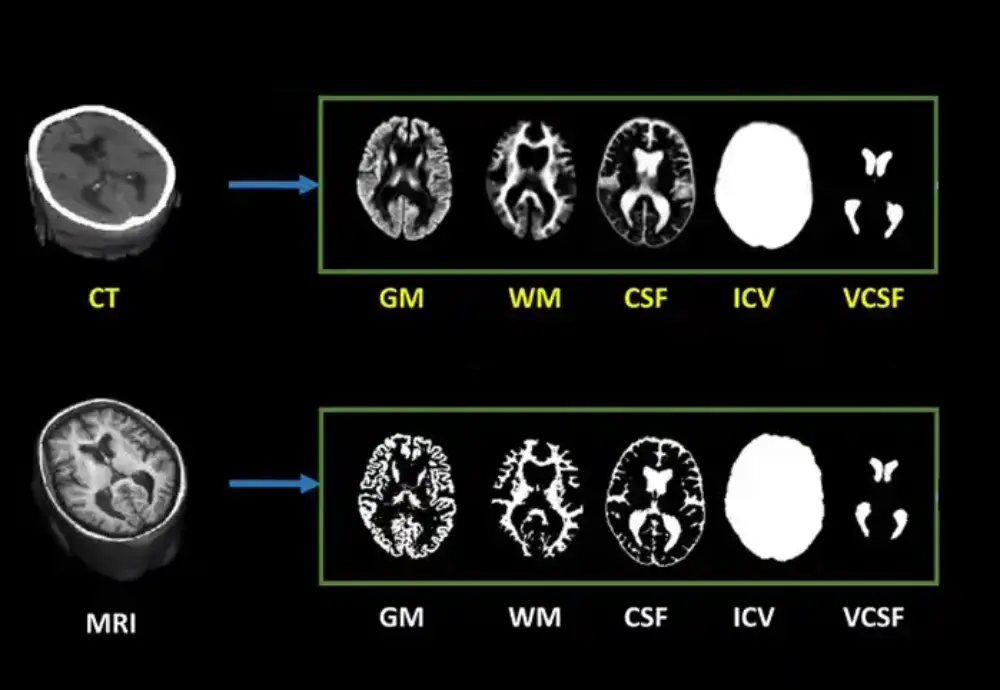 Napredna AI metoda transformiše dijagnostiku mozga putem CT skeniranja