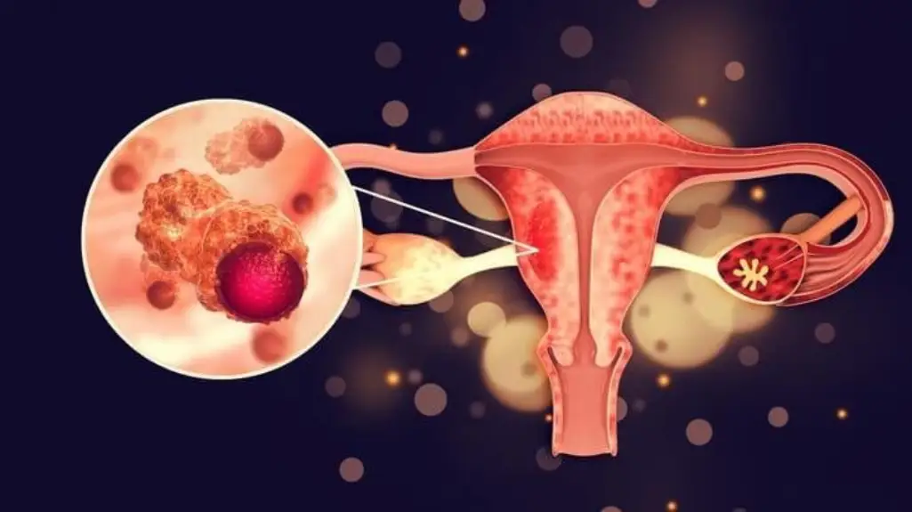 Nova otkrića mogu dovesti do poboljšanja tretmana raka jajnika otpornog na hemoterapiju