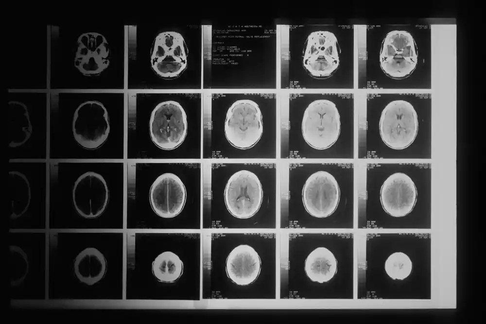 Nova studija pokazuje potencijal oporavka kod pacijenata sa traumatskom povredom mozga