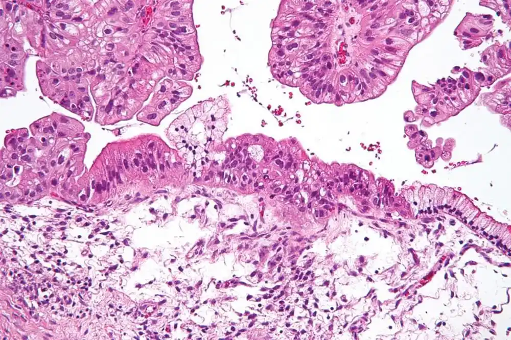 Naučnici otkrivaju moćne i selektivne inhibitore za lečenje raka jajnika