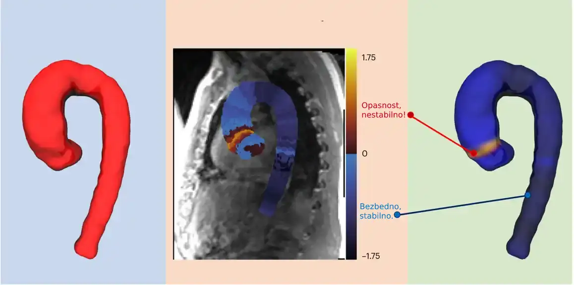 Nestabilno ‘treperenje’ predviđa aneurizmu aorte sa 98% tačnosti