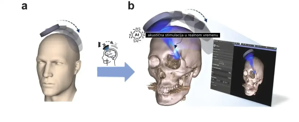 Veštačka inteligencija smanjuje barijeru za lečenje bolesti mozga ultrazvukom