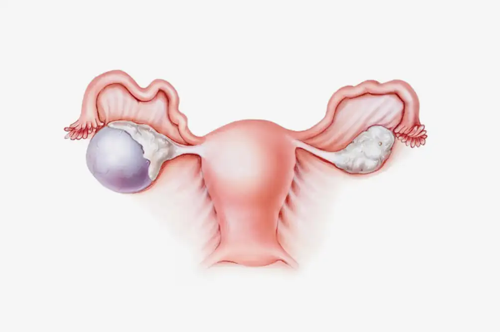 Studija pruža uputstva kliničara o praćenju cista na jajnicima