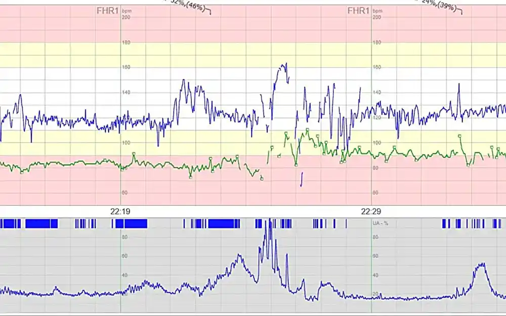 Studija otkriva da snimanje pulsa majke tokom porođaja smanjuje rizik od encefalopatije kod novorođenčadi