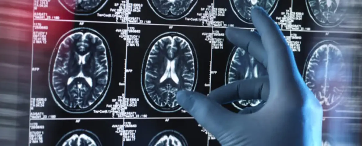 Čini se da je dugi COVID povreda mozga, otkrivaju naučnici