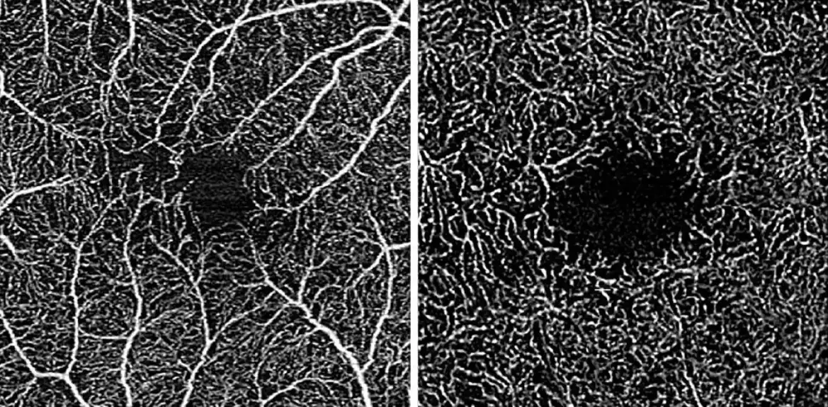 Istraživači testiraju novu metodu snimanja za praćenje retke bolesti oka