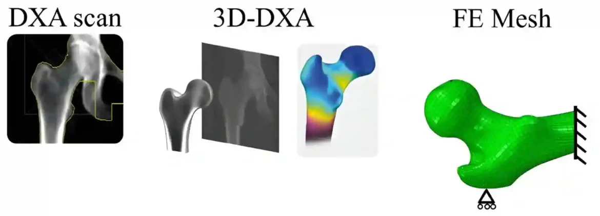 Novi dijagnostički alat za femoralnu osteoporozu poboljšava efikasnost i održivost postojećih metoda