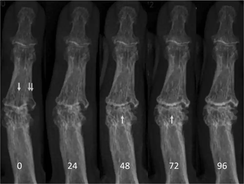 Proboj u blokadi erozije: kliničko ispitivanje signalizira nadu za osteoartritis šake