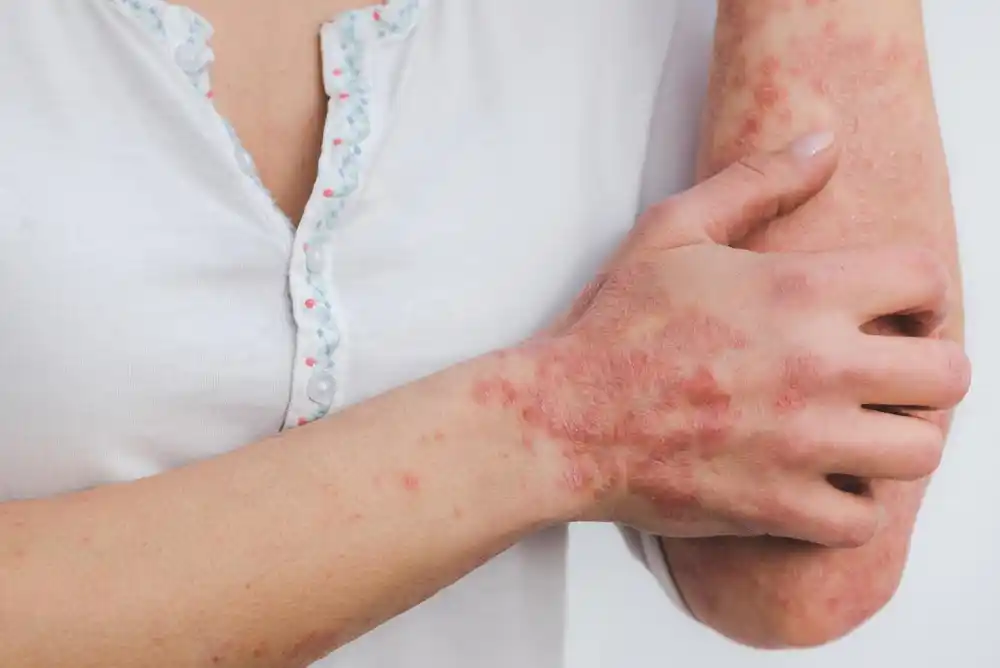 Psorijaza i ekcem imaju složene uzroke i posledice koje istraživači žele da otkriju