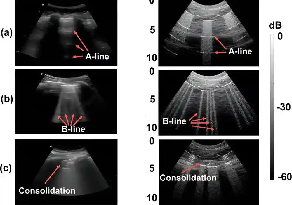 AI sada može da otkrije COVID-19 na ultrazvučnim slikama pluća