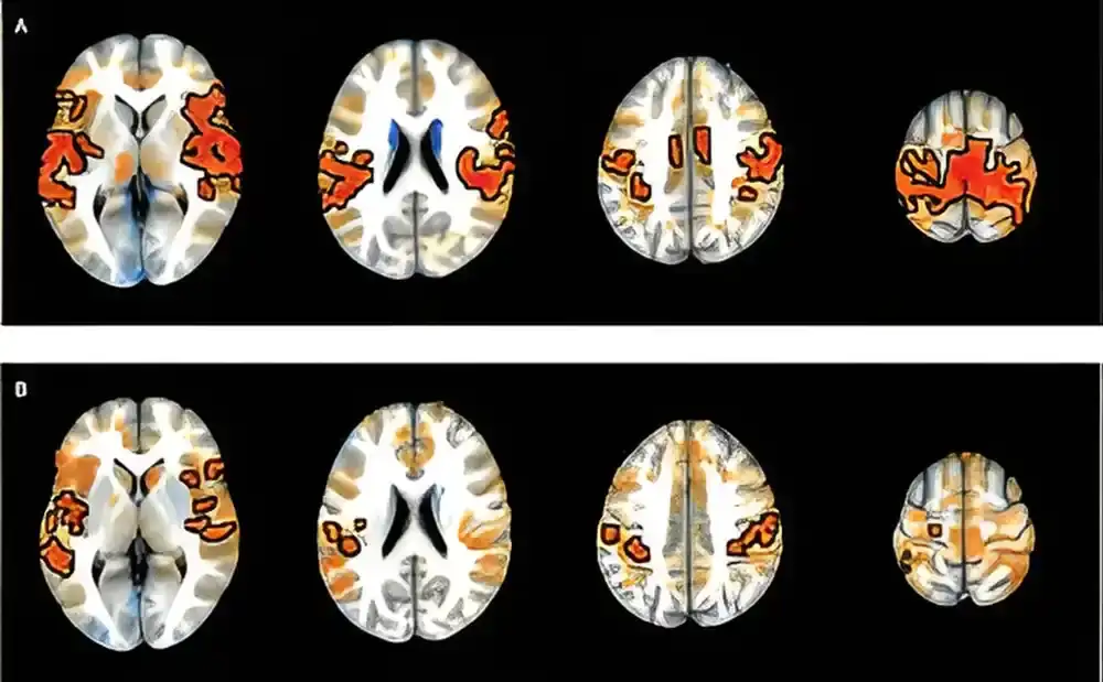 Istraživači identifikuju moždane veze povezane sa ADHD-om u mladosti