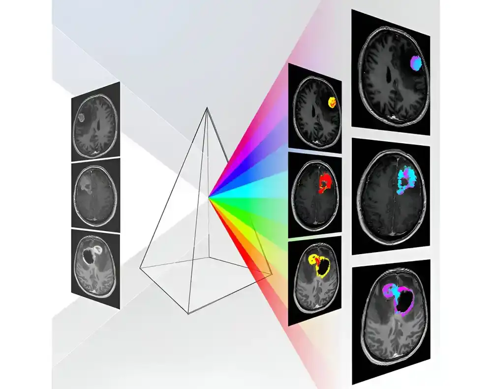 Nova AI tehnologija „DISCERN“ poboljšava dijagnostiku tumora mozga