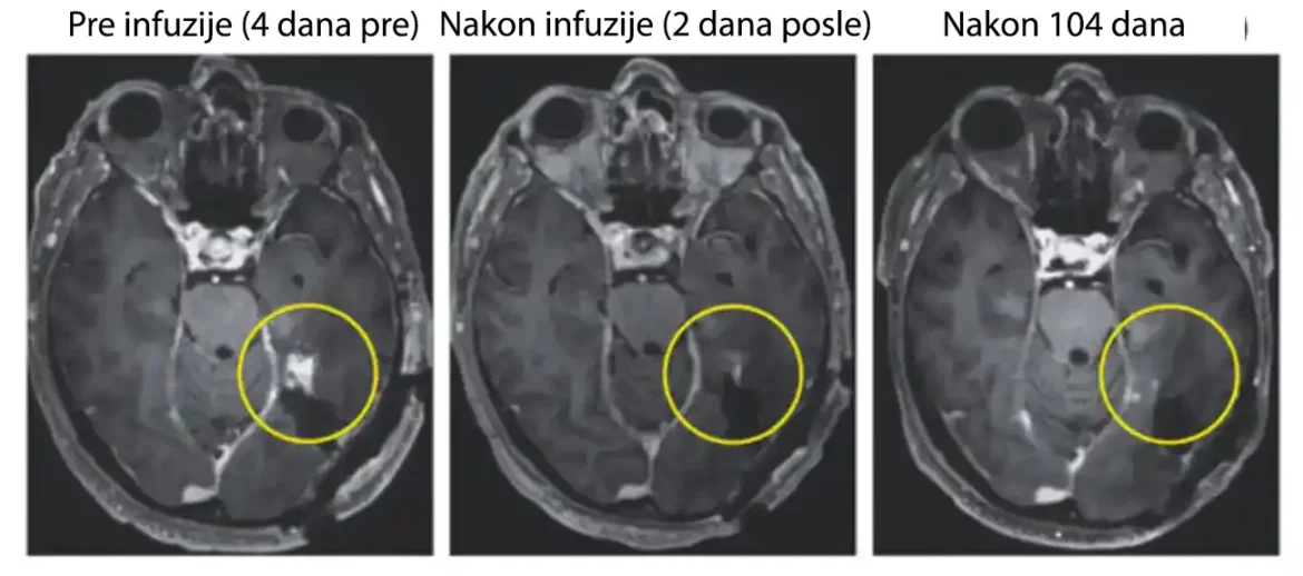 Nova terapija uklanja smrtonosni tumor mozga za nekoliko dana