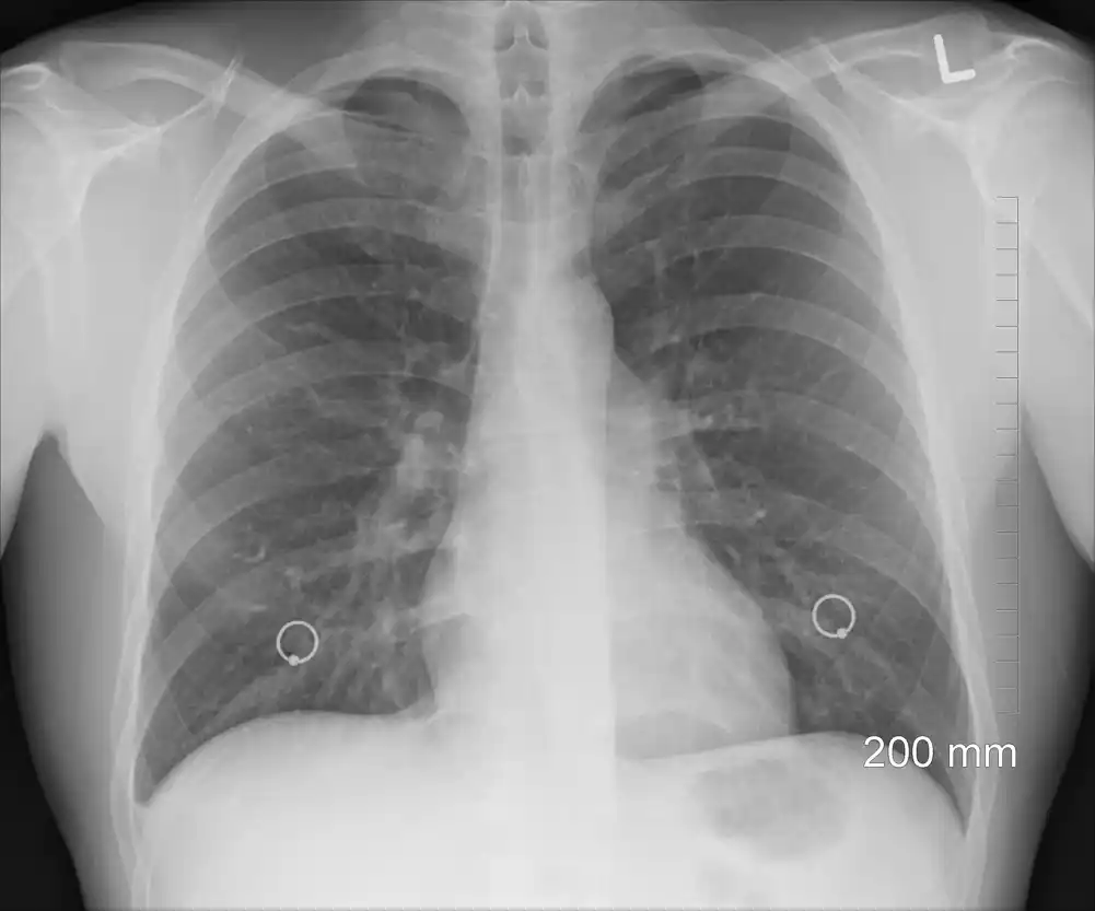 Skoro 10% transplantacija pluća u SAD ide pacijentima sa COVID-19