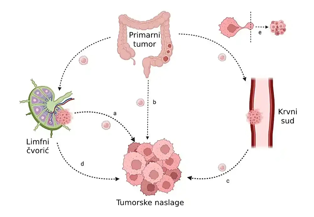 Depoziti tumora kod raka debelog creva i želuca