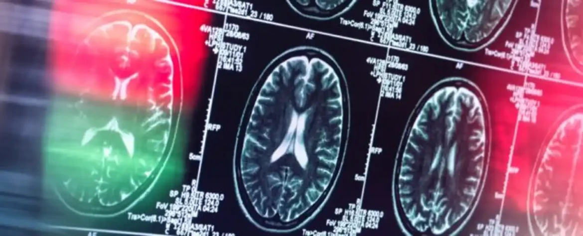 Naučnici otkrivaju 2 ključna moždana sistema iza psihoze