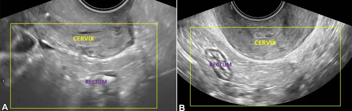 Nova izjava o konsenzusu ima za cilj da poboljša procenu endometrioze