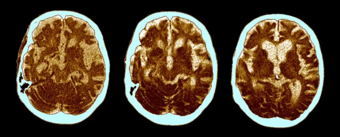 Skriveni uzrok Alchajmerove bolesti možda je identifikovan pre jednog veka
